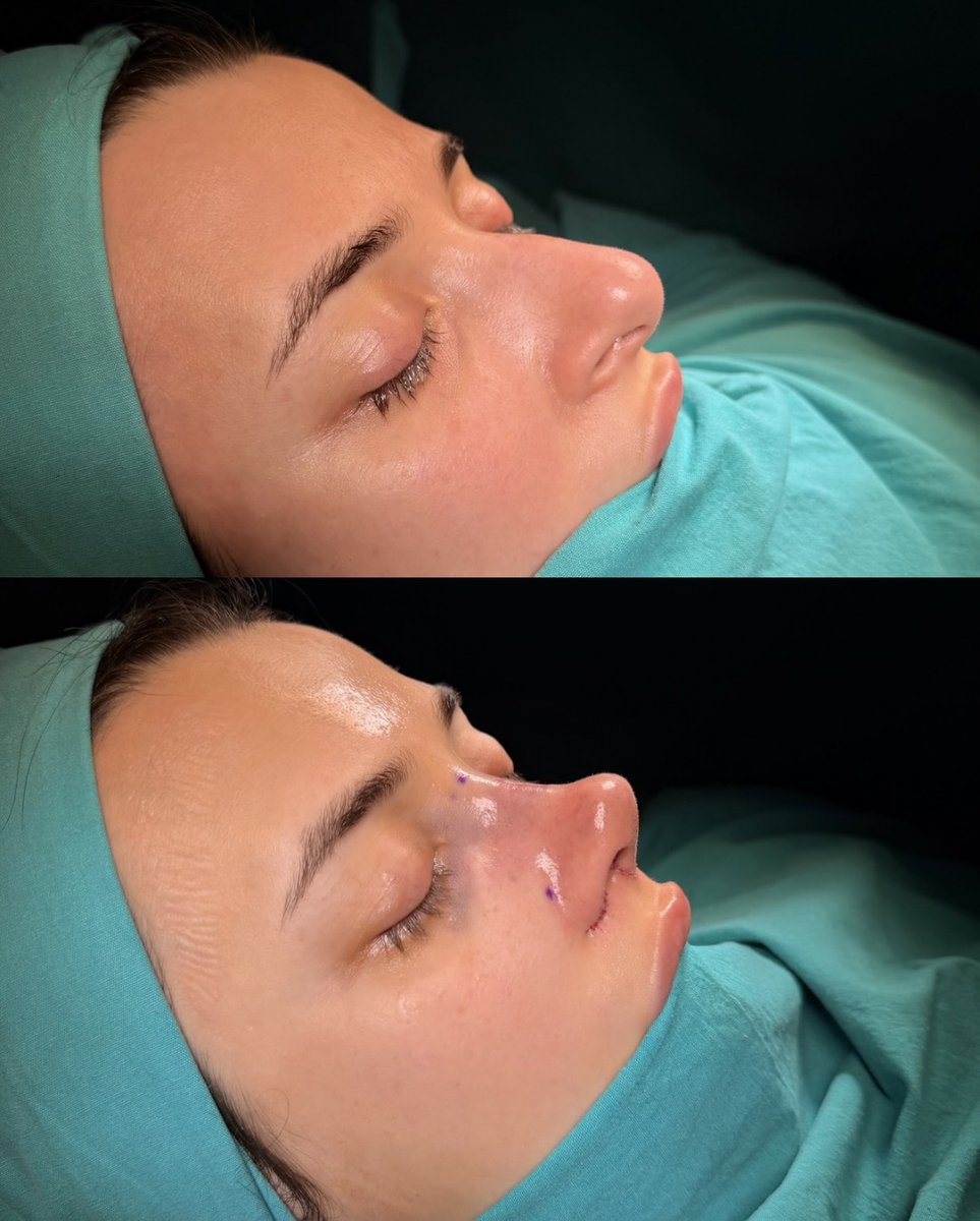 alevcamcioglu's tweet photo. Female Nose Job Before After Istanbul, Turkey 

 Contact us to get information about rhinoplasty.  

Webpage: https://t.co/x91oeZ4ECk  

Prices and Packages: https://t.co/BWZE5UWvn6  

Before & After Photos: https://t.co/ubAkZGWZZ9  

+(90)532 477 64 96 🇹🇷
 +(90)535 206 10 95 🇬🇧🇩🇪  

Our clinic is a recognized International Health Tourism Center by the Turkish Ministry of Health. Under the terms of this authorization and with the patient’s consent, the patient’s picture is used.  All our posts are for informational purposes .

  #rhinoplasty #rhinoplastyresults #rhinoplastyturkey #rhinoplastyspecialist #rhinoplastybeforeandafter #rhinoplastyistanbul