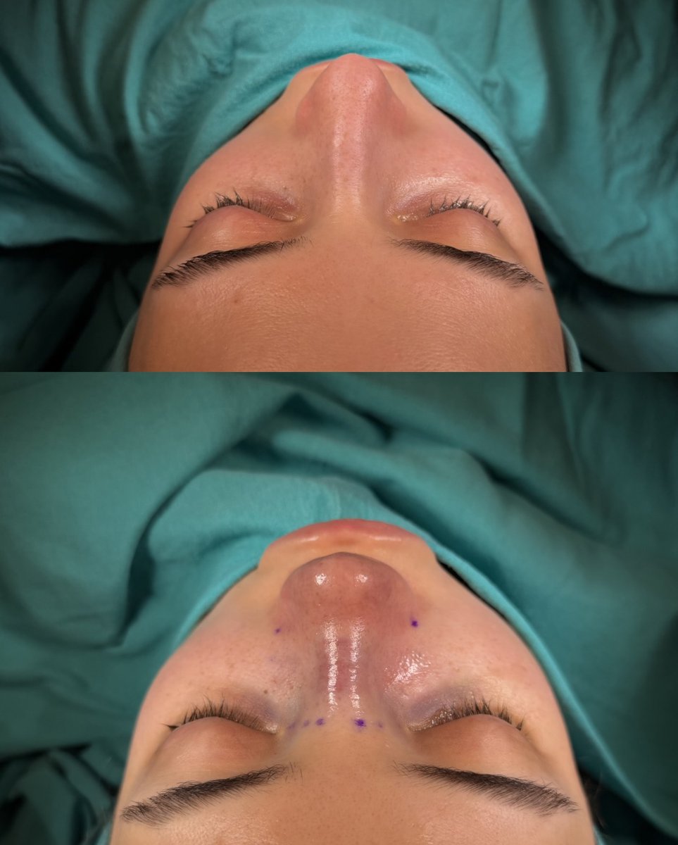 alevcamcioglu's tweet photo. Female Nose Job Before After Istanbul, Turkey 

 Contact us to get information about rhinoplasty.  

Webpage: https://t.co/x91oeZ4ECk  

Prices and Packages: https://t.co/BWZE5UWvn6  

Before & After Photos: https://t.co/ubAkZGWZZ9  

+(90)532 477 64 96 🇹🇷
 +(90)535 206 10 95 🇬🇧🇩🇪  

Our clinic is a recognized International Health Tourism Center by the Turkish Ministry of Health. Under the terms of this authorization and with the patient’s consent, the patient’s picture is used.  All our posts are for informational purposes .

  #rhinoplasty #rhinoplastyresults #rhinoplastyturkey #rhinoplastyspecialist #rhinoplastybeforeandafter #rhinoplastyistanbul