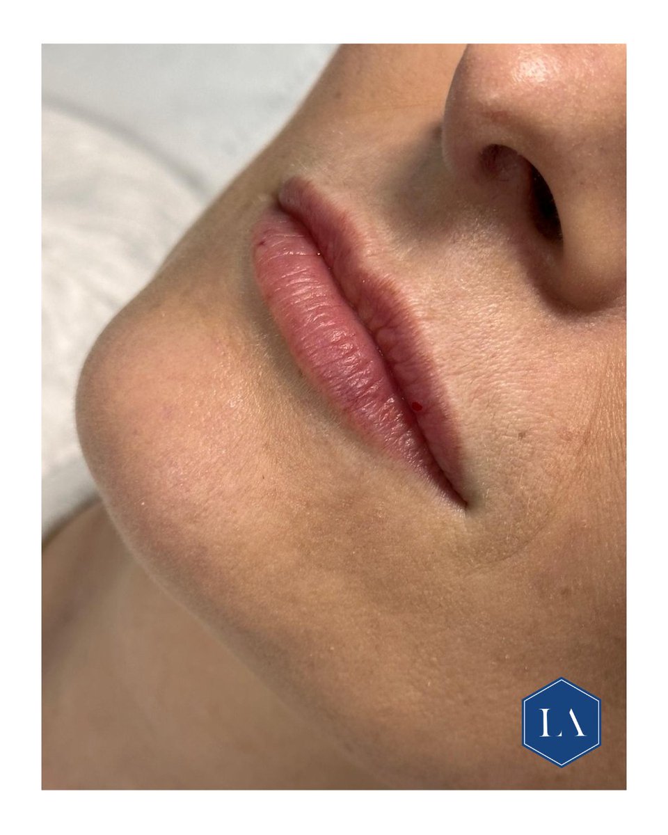 Enhancing natural beauty and restoring
lost volume/hydration with 0.5mls.

Photos taken immediately post procedure.
Minimal trauma.
No Russian lip technique in sight!
No one-size fits all!
No package deals!

THIS is what I call art!!

#luxtonaesthetics 
#19yearsofexcellence