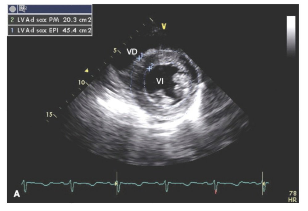 javier20ch's tweet photo. Grosor Parietal Relativo [GPR]. 🫀💢
🔶️El GPR es una variable sencilla, pero con enorme valor fisiopatológico y pronóstico en la evaluación ecocardiográfica del VI.
🔶️Se define como: GPR = 2 × EPP / DIVId.
🔸️EPP = espesor de la pared posterior en diástole.
🔸️DIVId = diámetro interno del VI en diástole.
🔶️El GPR no mide masa. Mide geometría ventricular. Y esa diferencia es clave. Mientras la masa ventricular izquierda cuantifica hipertrofia, el GPR describe cómo se distribuye esa hipertrofia en relación con la cavidad. Es decir, nos dice si el remodelado es concéntrico o excéntrico.
🔸️GPR ≤ 0.42 ➡️ geometría normal o hipertrofia excéntrica.
🔸️GPR > 0.42 ➡️ remodelado concéntrico o hipertrofia concéntrica.
🔸️Masa VI normal: <95 g/m² en♀️ y <115 g/m² en ♂️.
🔸️Fórmula para calcular masa del VI: 0.8 x (1.04 [DIVId + EPP + EPS)³ - (DIVI)³]) + 0.6 g.
🔶️Esto permite clasificar la geometría del VI en 4 patrones:
🔸️Geometría normal (GPR <0.42, masa normal).
🔸️Remodelado concéntrico (masa normal + GPR >0.42).
🔸️Hipertrofia concéntrica (masa aumentada + GPR >0.42).
🔸️Hipertrofia excéntrica (masa aumentada + GPR <0.42).
🔶️Es importante porque el remodelado concéntrico puede preceder al aumento de masa y ya se asocia con mayor riesgo CV, especialmente en cardiopatía hipertensiva. No todo paciente con hipertensión desarrolla hipertrofia franca, pero muchos desarrollan aumento del GPR como respuesta adaptativa a sobrecarga de presión. 🧐🔎🫀

📚Manual Washington de Ecocardiografía. 2ª Ed.