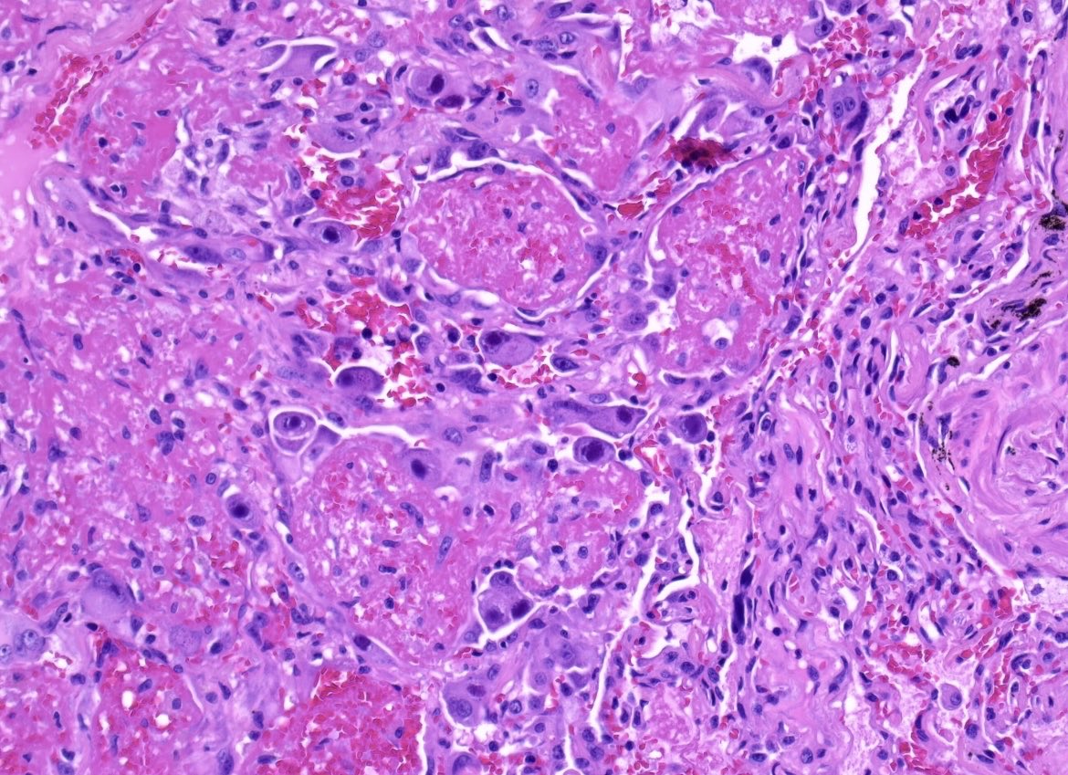 BrownPathology's tweet image. #pulmpath #lungpath #pathresidents #surgpath 

A 50 year old man with a lengthy smoking history and kidney transplant history presents with a lung nodule:

Poll and short discussion in reply.