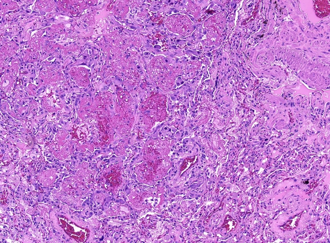 BrownPathology's tweet image. #pulmpath #lungpath #pathresidents #surgpath 

A 50 year old man with a lengthy smoking history and kidney transplant history presents with a lung nodule:

Poll and short discussion in reply.