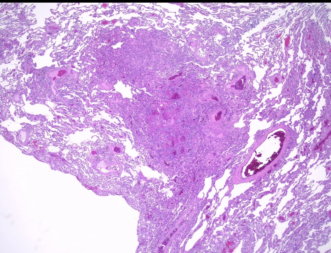 BrownPathology's tweet image. #pulmpath #lungpath #pathresidents #surgpath 

A 50 year old man with a lengthy smoking history and kidney transplant history presents with a lung nodule:

Poll and short discussion in reply.