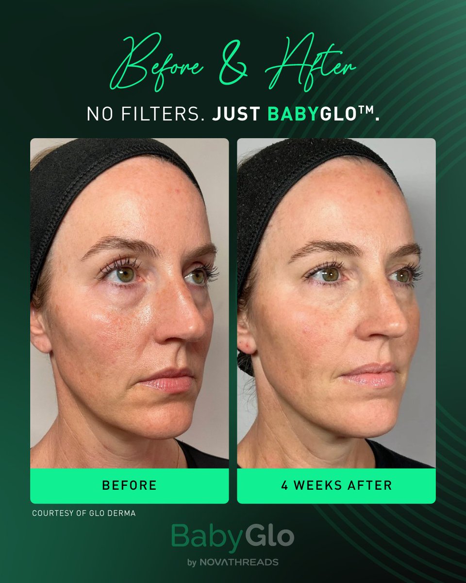 NovaThreads's tweet photo. The undetectable era? It’s officially in session. ✨👀

Just 4 weeks post-BabyGlo™… and the only thing noticeable is how effortless it looks. 💖

#novathreads #BabyGlo #UndetectableResults #KBeautyInspired #GlowUp https://t.co/I7unavNcLx