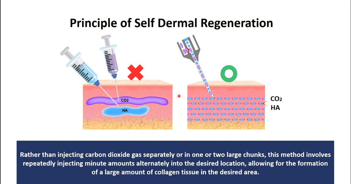 เธรดนี้จะมาเล่าโปรแกรมรักษา "หลุมสิว" ที่ดังมากๆในเกาหลี คนไทยบินแห่ไปทำเยอะมาก "โปรแกรม Juvgen" พึ่งเข้าไทยร้อนๆ คืออะไร? มาเล่าให้ฟังกันครับ