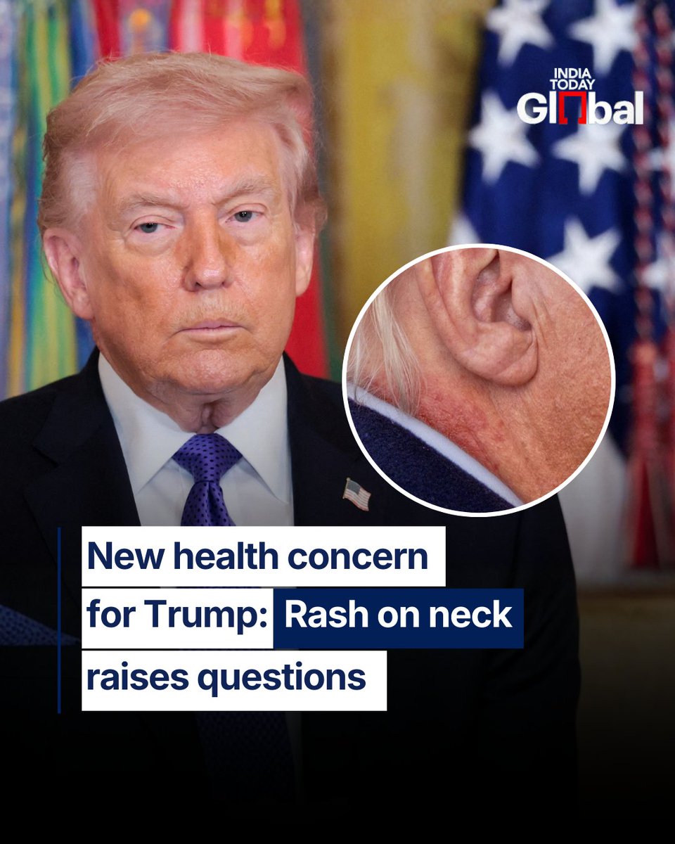 ITGGlobal's tweet image. US President Donald Trump is under fresh scrutiny as a rash appears on the side of his neck. Earlier health concerns included a bruised hand and swollen ankles, keeping the spotlight on the president’s well-being.

#Trump #USPresident #HealthWatch #USPolitics #IndiaTodayGlobal