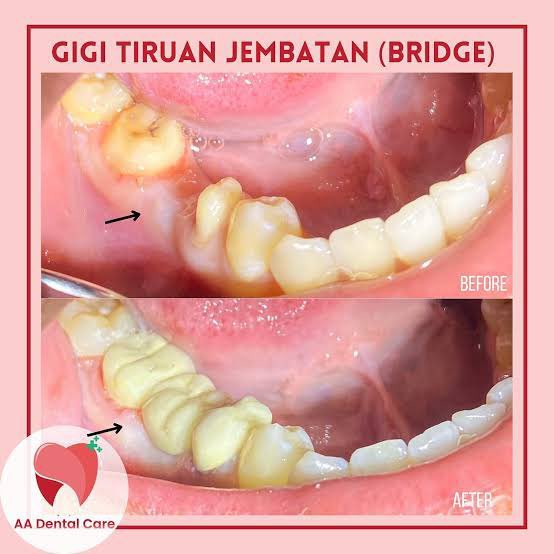 Kaylaaiy's tweet photo. Bagi teman teman dengan usia diatas 25 tahun yg memiliki keluhan ompong 1 gigi geraham bawah (seperti foto) &amp; ingin dibuatkan gigi palsu tiruan/bridge oleh dokter gigi muda/koas gigi RSGM daerah Jakarta Barat tanpa dipungut biaya boleh komen dibawah ya😊🙏🏻 #caripasien #koasgigi https://t.co/qXzI5gFqjW