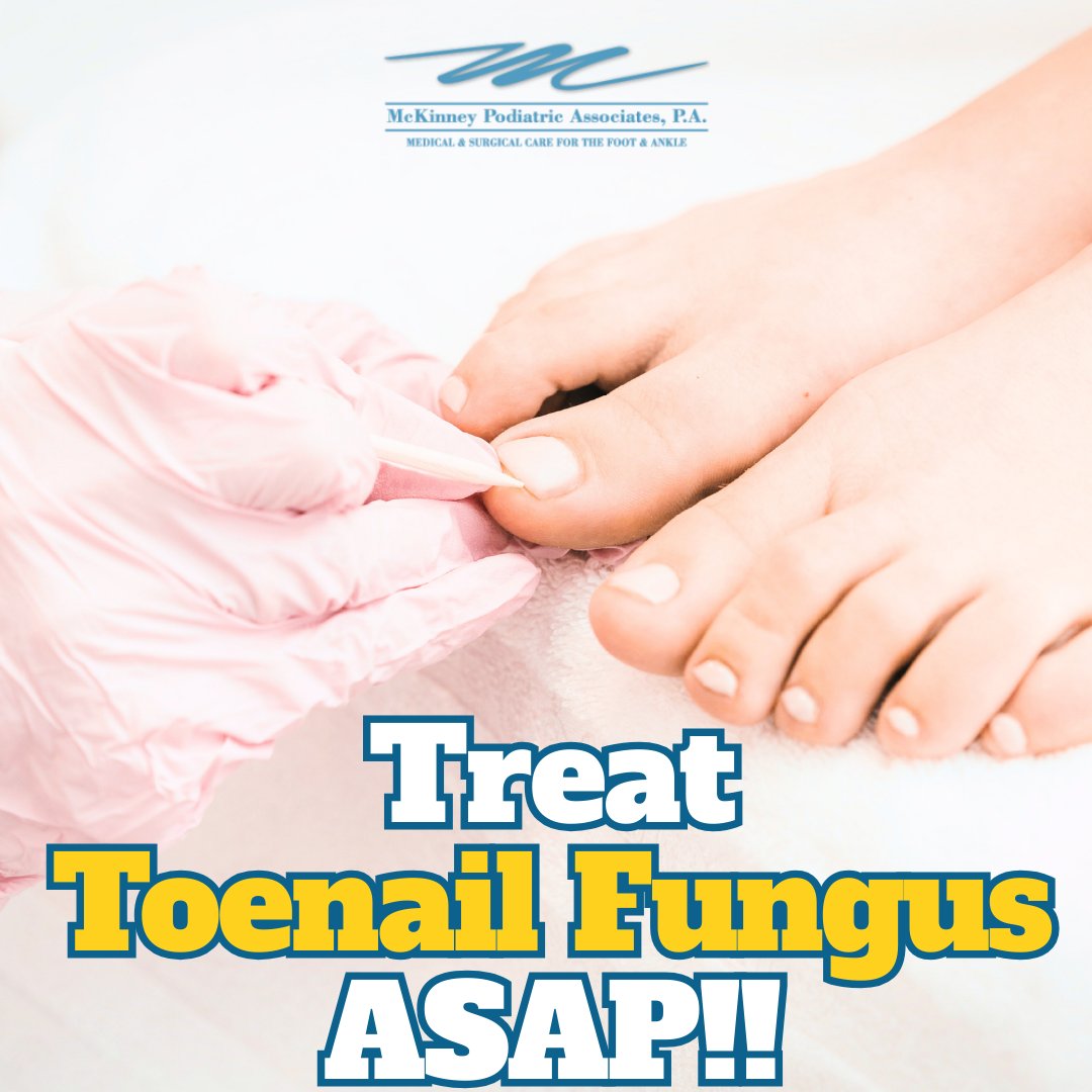 Early treatment can improve nail appearance and comfort while limiting spread. If you have symptoms of toenail fungus, it is suggested that you schedule an appointment with  a podiatrist for appropriate treatment solutions.

mpa-web.com/blog/itemlist/…

#podiatrist #toenailfungus