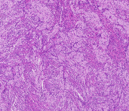 Janiranavarro's tweet photo. Non-ossifying fibroma (NOF), see pics 1 and 2  
Benign fibrohistiocytic tumor arising in the metaphysis of long bones in skeletally immature individuals (children)

Adult epiphyseal "NOF-like" lesions were previously called benign fibrous histiocytoma of bone but are now considered giant cell tumor of bone with degenerative changes.  
H3.3 G34W IHC positivity supports GCTB (negative in NOF).

Dr. Lauer - Tips and Hints in Surgical Pathology #USCAP #pathology #PathX #PathTwitter