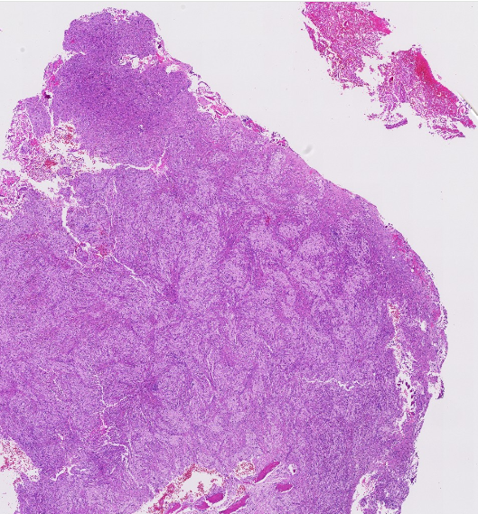 Janiranavarro's tweet photo. Non-ossifying fibroma (NOF), see pics 1 and 2  
Benign fibrohistiocytic tumor arising in the metaphysis of long bones in skeletally immature individuals (children)

Adult epiphyseal "NOF-like" lesions were previously called benign fibrous histiocytoma of bone but are now considered giant cell tumor of bone with degenerative changes.  
H3.3 G34W IHC positivity supports GCTB (negative in NOF).

Dr. Lauer - Tips and Hints in Surgical Pathology #USCAP #pathology #PathX #PathTwitter