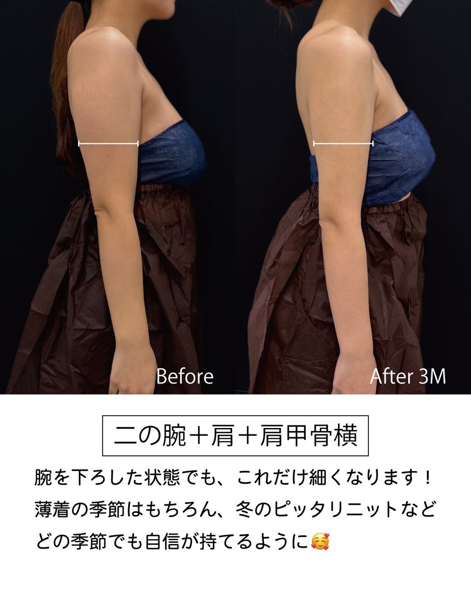 dr_reiya's tweet photo. ◎二の腕脂肪吸引　術前→3ヶ月
(二の腕+肩+肩甲骨横)

脂肪吸引でどの角度でも細く綺麗な腕周りに💪🏼
長袖だとダウンタイムも隠せるので、今の時期がとってもおすすめです！

脂肪吸引/脂肪吸引注射が気になる方は
是非れいや先生にお任せください❣️

ご予約はプロフィールのリンクから👈

皆様のご来院お待ちしております✨ 

【脂肪吸引といえばれいや先生】

美ボディ脂肪吸引（全部位総合）症例数1位🥇
(2024年下半期SBC内　関西エリア）
糸リフト（プリマ） 症例数2位🥈
(2024年上半期SBC内九州沖縄エリア）

………………………………………………
🏥イテウォンビューティークリニック神戸院
📍 兵庫県神戸市中央区御幸通6-1-10
オリックス神戸三宮ビル 5階
🏃‍♂️JR三ノ宮駅徒歩5分
⏰ 9:00〜18:00▶︎不定休
☎️0120-832-900
………………………………………………
#二の腕脂肪吸引