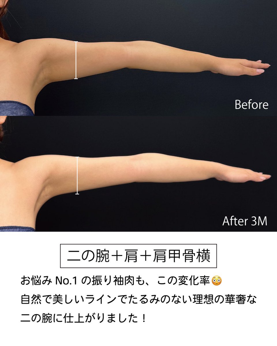 dr_reiya's tweet photo. ◎二の腕脂肪吸引　術前→3ヶ月
(二の腕+肩+肩甲骨横)

脂肪吸引でどの角度でも細く綺麗な腕周りに💪🏼
長袖だとダウンタイムも隠せるので、今の時期がとってもおすすめです！

脂肪吸引/脂肪吸引注射が気になる方は
是非れいや先生にお任せください❣️

ご予約はプロフィールのリンクから👈

皆様のご来院お待ちしております✨ 

【脂肪吸引といえばれいや先生】

美ボディ脂肪吸引（全部位総合）症例数1位🥇
(2024年下半期SBC内　関西エリア）
糸リフト（プリマ） 症例数2位🥈
(2024年上半期SBC内九州沖縄エリア）

………………………………………………
🏥イテウォンビューティークリニック神戸院
📍 兵庫県神戸市中央区御幸通6-1-10
オリックス神戸三宮ビル 5階
🏃‍♂️JR三ノ宮駅徒歩5分
⏰ 9:00〜18:00▶︎不定休
☎️0120-832-900
………………………………………………
#二の腕脂肪吸引