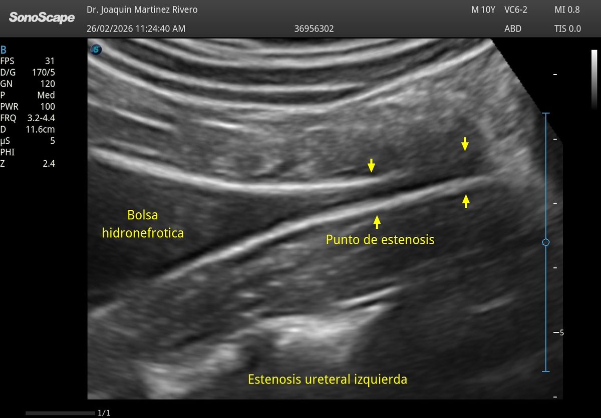 JMMR83's tweet photo. Estenosis pieloureteral/ureteral proximal
@NephroP @PierpaDiNick @y_interna @yaletung @SonoSamMD @ABCDEcografia @ignaciomsb @AlvarezHigueras @jpalacinp @USPed_Latam @GTEcoPed @GTECOSEMI https://t.co/HxUI0IMqls