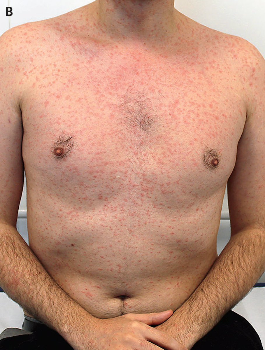 NEJM's tweet image. Images in Clinical Medicine: Primary Measles Infection nej.md/4tSKIiB 

#DermTwitter #IDTwitter