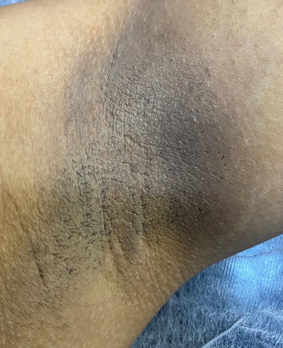 NeresDepil's tweet photo. Clareamento de axilas com preço especial até 07/03 .. de R$ 320,00 por R$ 250,00
Agende pelo WhatsApp 21 967223775 https://t.co/4qsIB87IpW