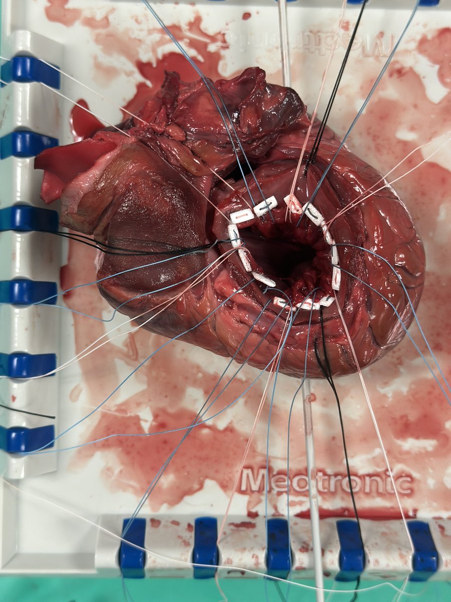 UABCTSResidency's tweet photo. Thanks to @pannvar for an excellent skills lab on mitral valve replacement. Dr. Vardas has been an incredible educator and mentor; we will miss him as he transitions to @TuftsMedicalCtr as the incoming chief of cardiac surgery. Thank you Dr. Vardas!
@UABSurgery #whyUABCT https://t.co/UpMTIfoPzj