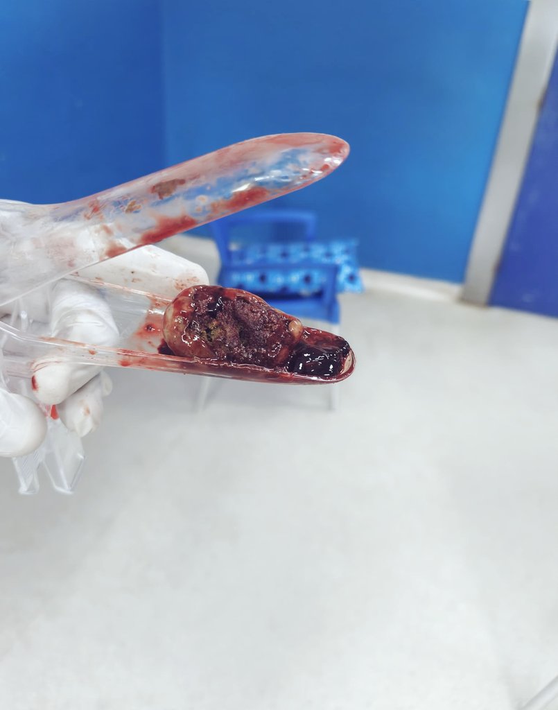 J'ai examiner aujourd'hui une patient qui présentait un  Coma, syndrome infectieux et des saignements. Au cours de l'examen, j'ai découvert ce truc (voir image)dans le vagin.  Elle aurait acheté ça avec un Monsieur pour soigner ses kystes de l'ovaire