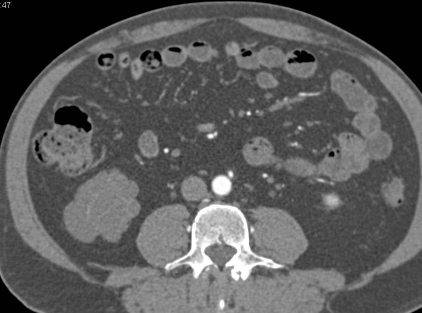 Elliot K Fishman / CTisus.com tweet media