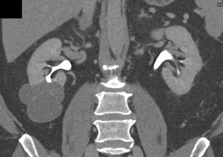 Elliot K Fishman / CTisus.com tweet media