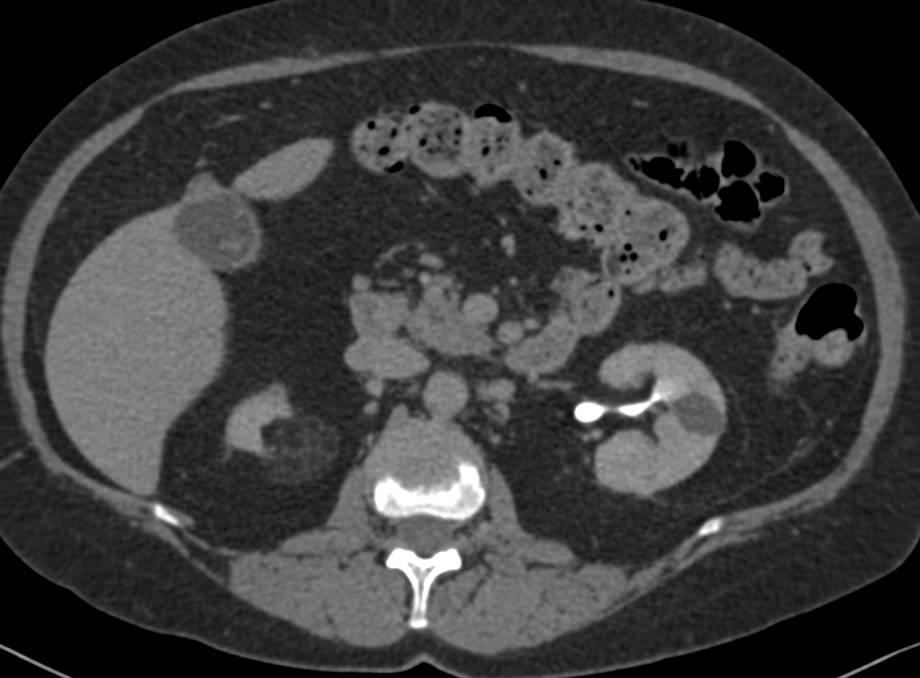 Elliot K Fishman / CTisus.com tweet media