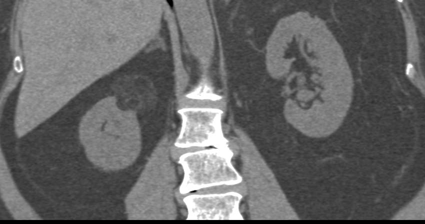 Elliot K Fishman / CTisus.com tweet media