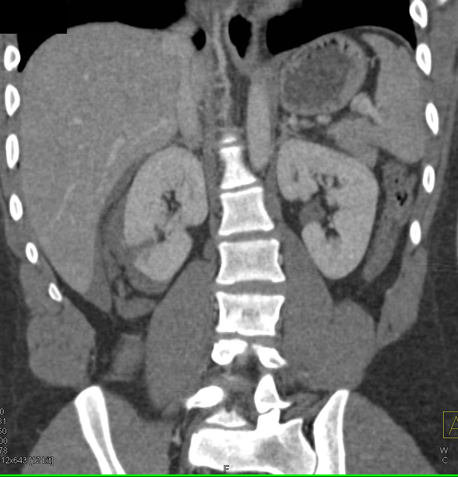 Elliot K Fishman / CTisus.com tweet media