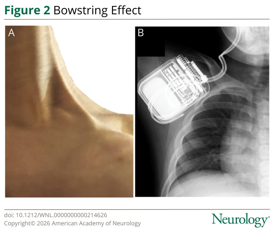 GreenJournal's tweet image. Intracranial neuromodulation in drug-resistant pediatric and adult #epilepsy demonstrated an acceptable safety profile across sexes and age groups. However, children and patients with 4-lead DBS systems were at increased risk of the bowstring effect: hubs.la/Q044j4Fd0