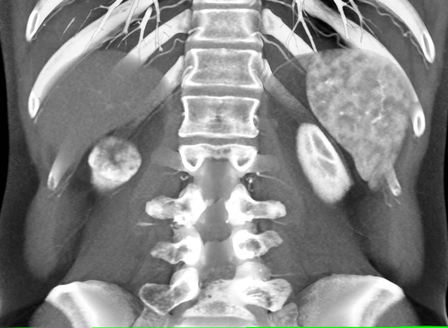 Elliot K Fishman / CTisus.com tweet media