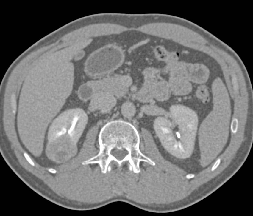 Elliot K Fishman / CTisus.com tweet media