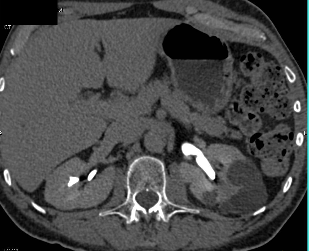 Elliot K Fishman / CTisus.com tweet media