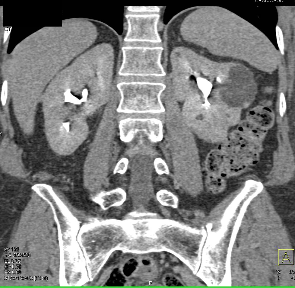 Elliot K Fishman / CTisus.com tweet media