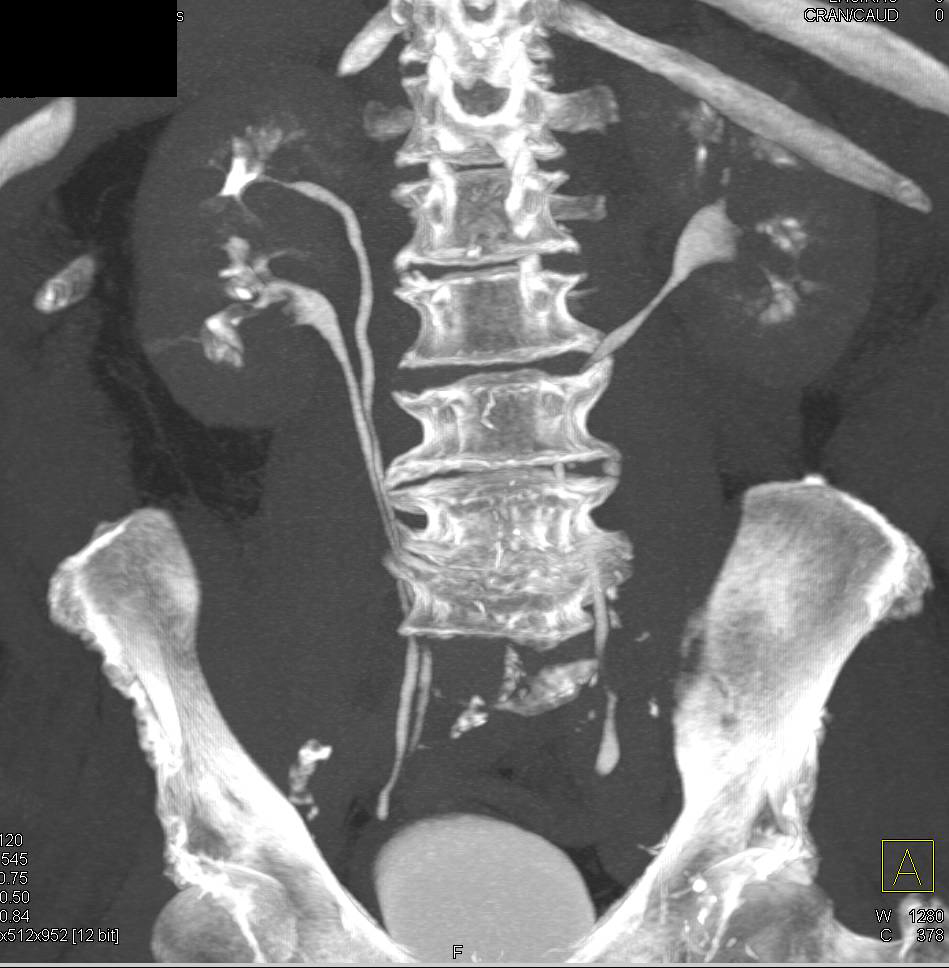 Elliot K Fishman / CTisus.com tweet media