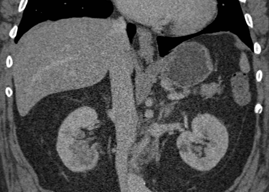 Elliot K Fishman / CTisus.com tweet media