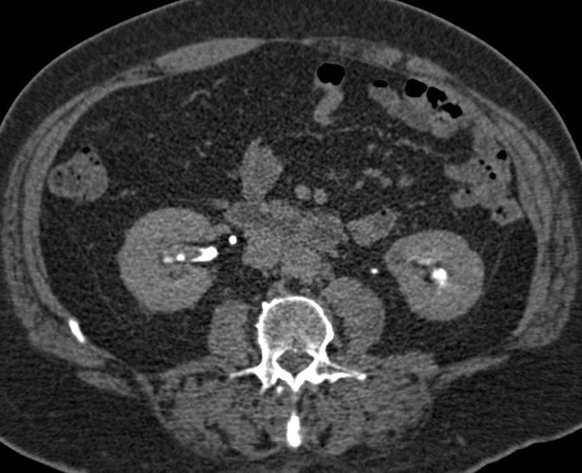 Elliot K Fishman / CTisus.com tweet media