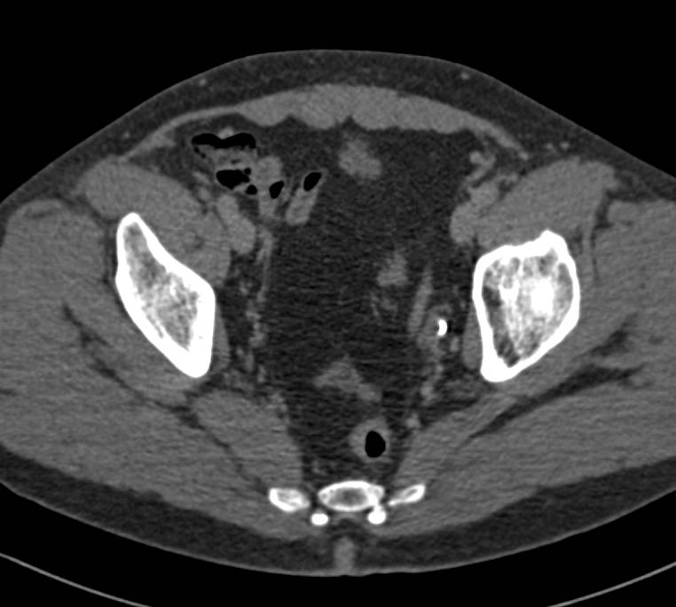 Elliot K Fishman / CTisus.com tweet media