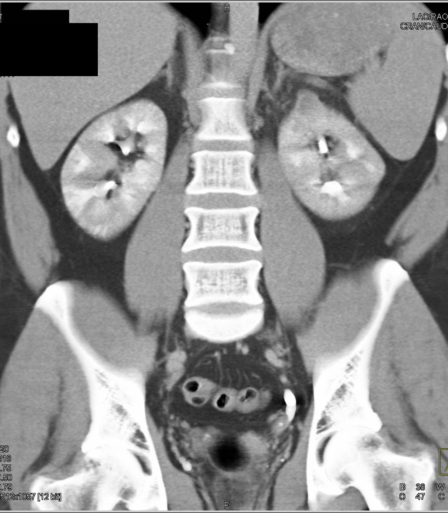 Elliot K Fishman / CTisus.com tweet media