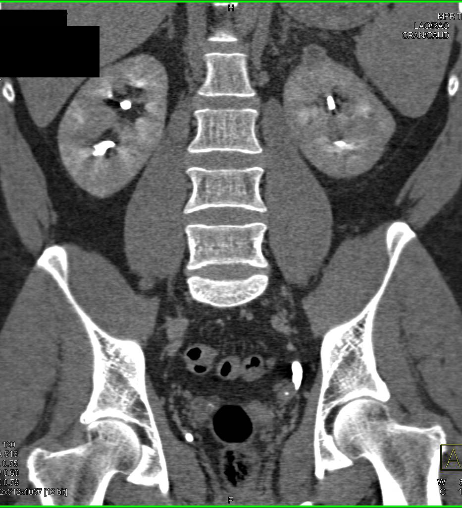 Elliot K Fishman / CTisus.com tweet media