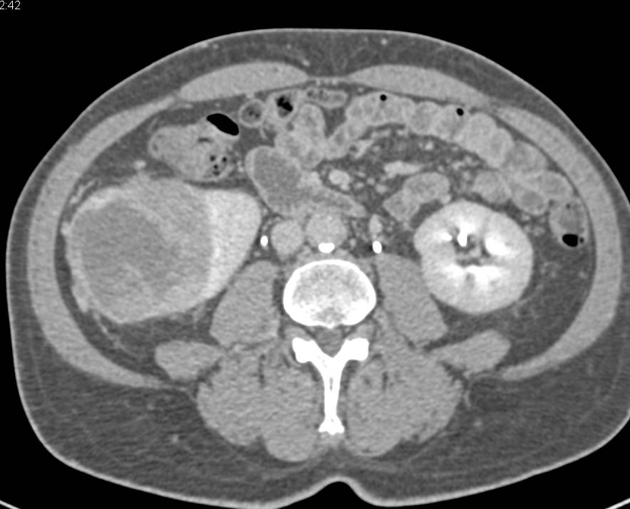 Elliot K Fishman / CTisus.com tweet media