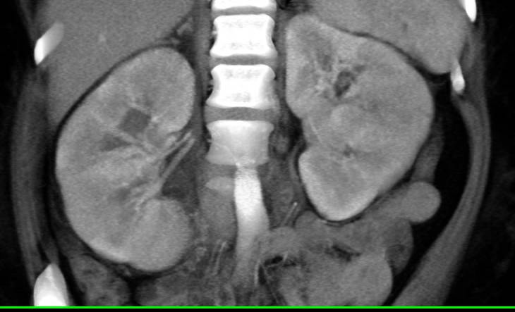 Elliot K Fishman / CTisus.com tweet media