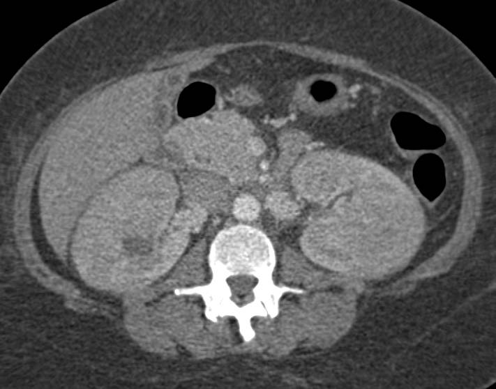 Elliot K Fishman / CTisus.com tweet media