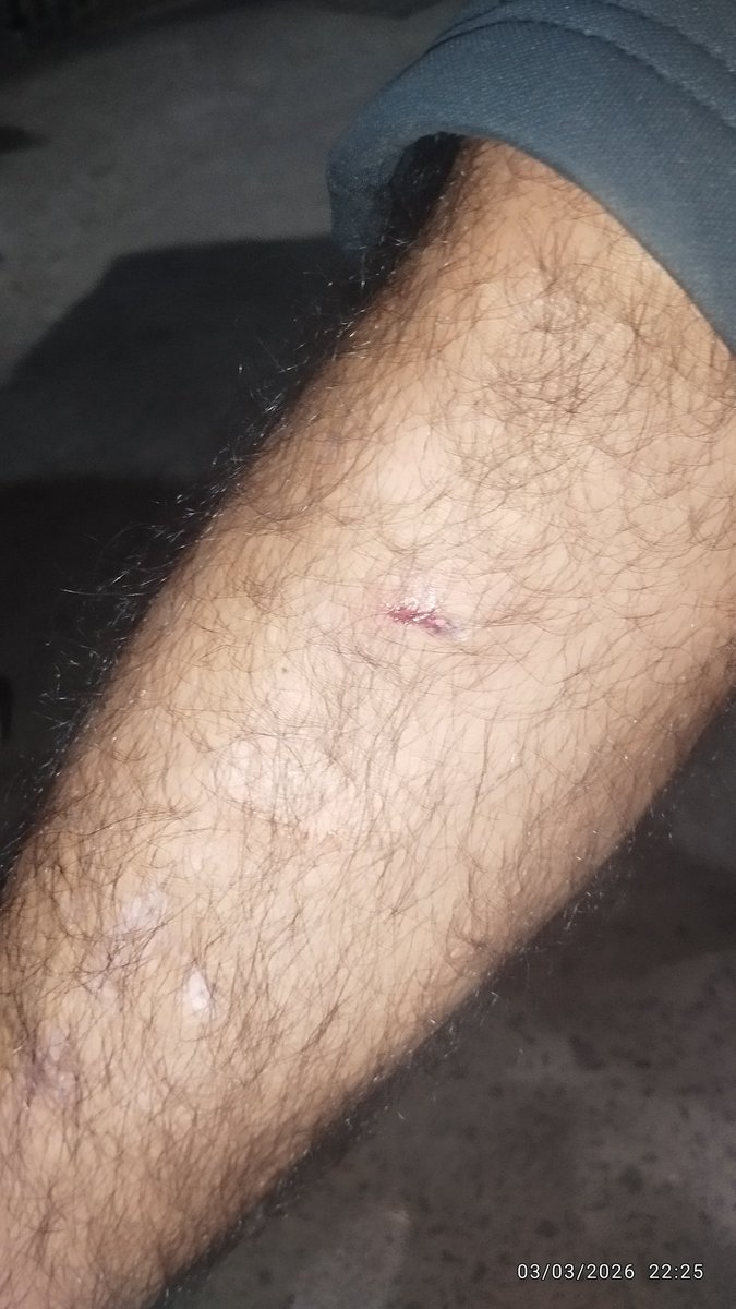 Raman_RTI's tweet photo. @Swiggy @SwiggyCares : Ur delivery parter #Sardar Damneet Singh ws bringing my #foodorder #231525266068140. Sadly, On the way from restaurant , a Street Dog bite him badly. Plz #Takecare of this young boy. Despite his #pain, he #respectfully delivrd his order. Respect. #Jammu https://t.co/SZglJaJMpg