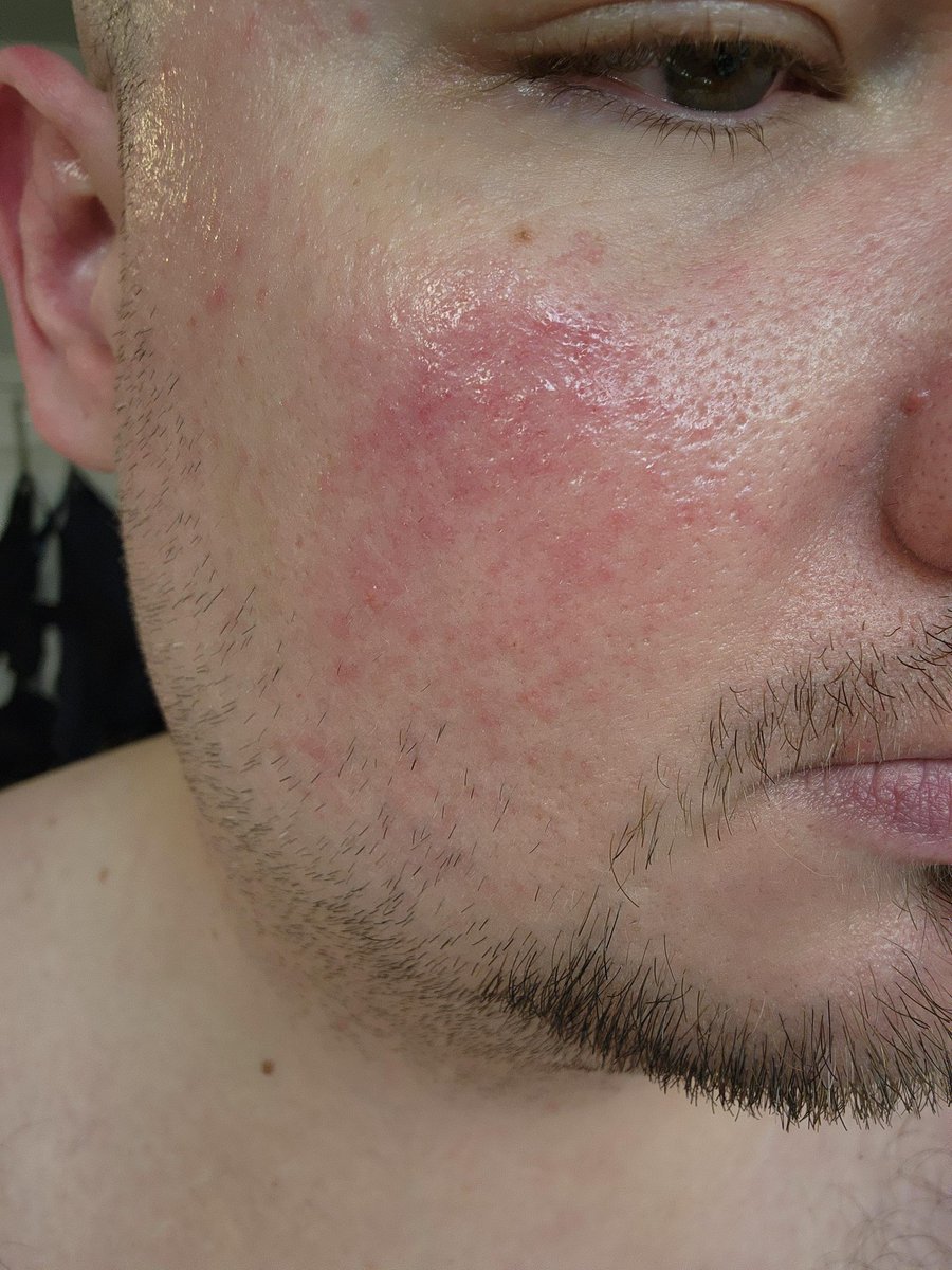 drcole01's tweet photo. Before and after 4 days of topical ivermectin treatment https://t.co/tDjaD3RL6w