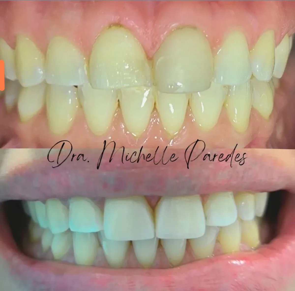 michejoseline's tweet photo. Hablemos de carillas.
Sí tienes carillas, iguales a las de la foto #1, te diré que pagaste por gusto. El objetivo de realizar carillas es hacerlo lo más natural posible. 
Te enseño como su sonrisa cambió completamente con sólo dos carillas de resina. Trabajo hecho por mí 📲 https://t.co/XoC2V3jbla