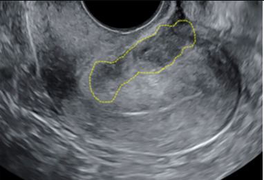 sruradiology's tweet photo. It's March, Endometriosis Awareness Month, something that affects 10% of reproductive-aged women. Now's the perfect time to review the 2024 SRU consensus statement for augmented ultrasound diagnosis of endometriosis: 
https://t.co/iInBtOFGGf 

#endometriosis #ultrasound https://t.co/sJDqtKM92n