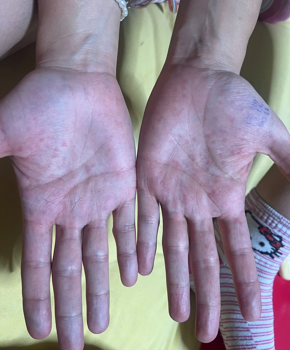 andres130108's tweet photo. Vecinos míos reportan salpullido debido a la condición insalubre del agua, presidenta @VeroDelgadilloG, gobernador @PabloLemusN pedidos su ayuda por que @siapagdl no da respuesta ni solución, @Trafico_ZMG queremos evitar más enfermos https://t.co/KhSgWxndwo