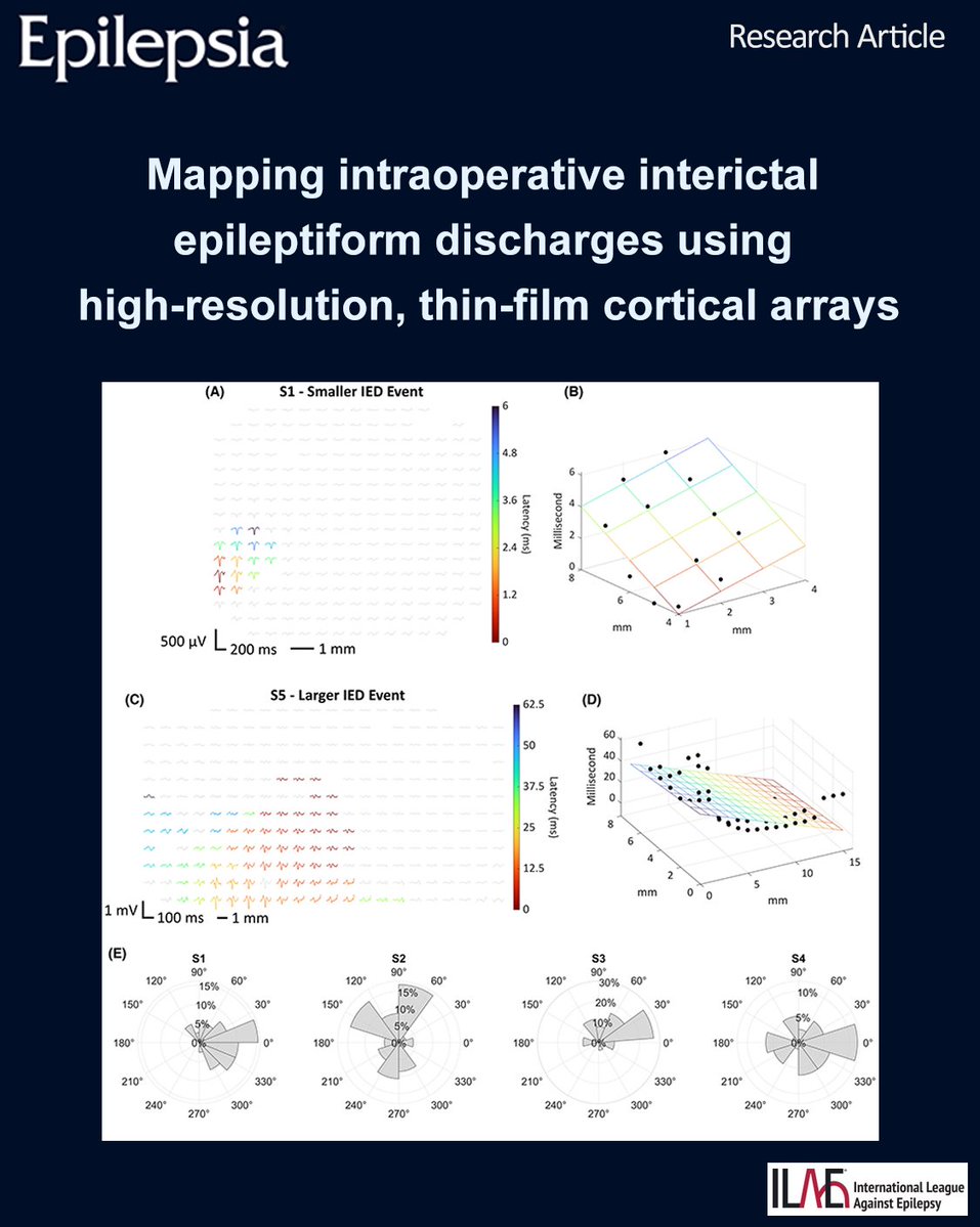 EpilepsiaJourn's tweet photo. Intraoperative μECoG array recordings demonstrate the localization of IEDs to subcentimeter areas of cortex.
https://t.co/ajdJtcpU3U

#epilepsy #ILAE #epilepsiajourn #drugresistant #epilepsysurgery #IED #interictalspikes #intraoperativemapping #microelectrocorticography https://t.co/CNJs3Cfu4H