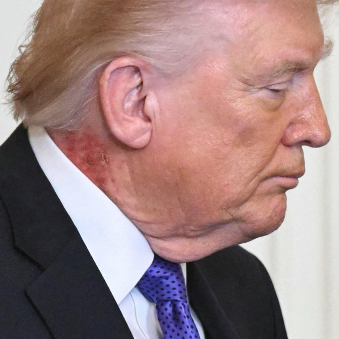 AlertesInfos's tweet photo. 🇺🇸 FLASH | Donald Trump a appliqué du maquillage pour masquer les rougeurs sur son cou. https://t.co/yHwzFBVJ0G
