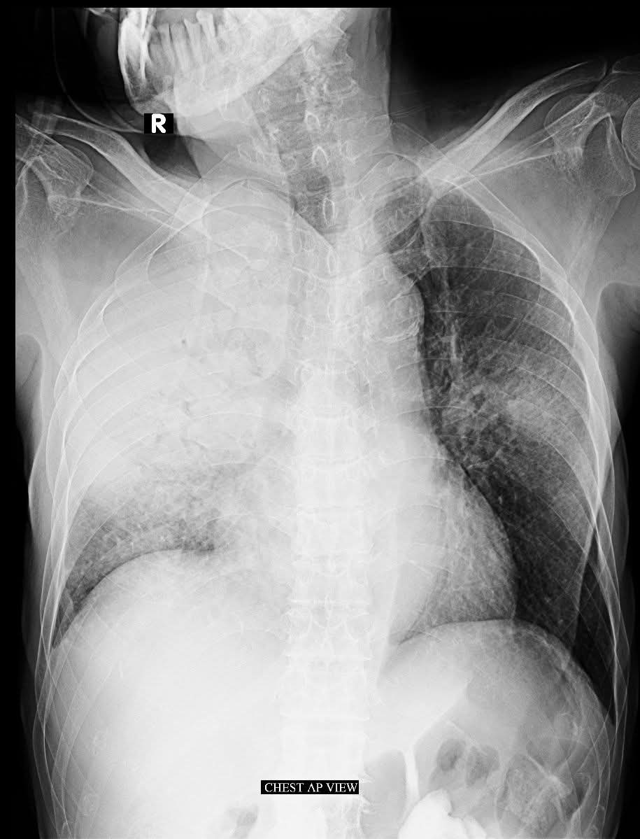 albertoortegana's tweet image. 83Y/M
C/C: shortness of breath 

#Radiology#MedicalImaging
#DiagnosticImaging #RadiologyEducation 
#InterestingCase #MedicalLearning 
@dr_manish_ydv @Dr_Shiv_kumar_ @DrAkhilX @IhabFathiSulima @DrMedica_13 @drobiy12 @hemo_shk