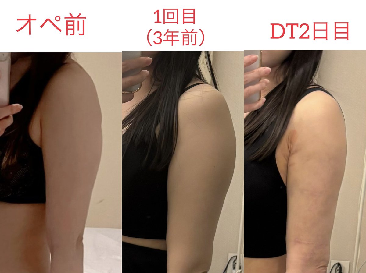 omochi_1991's tweet photo. 経過が良いのでレポあげます✨
2/25.26にドクターフィットクリニック（@OfficialClinic ）にてお腹、二の腕の脂肪吸引の修正を行いました♩
3年前に他院🇰🇷で凸凹にされたお腹をここまで綺麗にしていただき、大感謝😭
二の腕内側のみ内出血有ですが全体的にアザも少なく、DTが軽いです☘️
#脂肪吸引 https://t.co/qTStBq1BbS