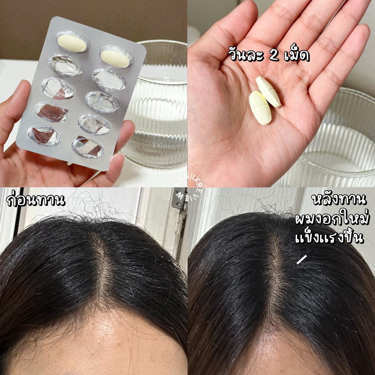 ใครผมร่วงเยอะ ๆ แนะนำให้ไปลองทานวิตามิน Nectahair ของ Nactapharma ตั้งแต่ทานมาผมร่วงน้อยลงมาก แล้วผมขึ้นใหม่ก็เยอะขึ้นมาก เป็นวิตามินที่มีสารสกัดที่ช่วยเรื่องผมถึง 18 ชนิด ช่วยเติมสารอาหารที่จำเป็นให้รากผมแข็งแรง กินวันละ 2 เม็ดก่อนนอน นี่ลองทานมาเกือบ 2 เดือน